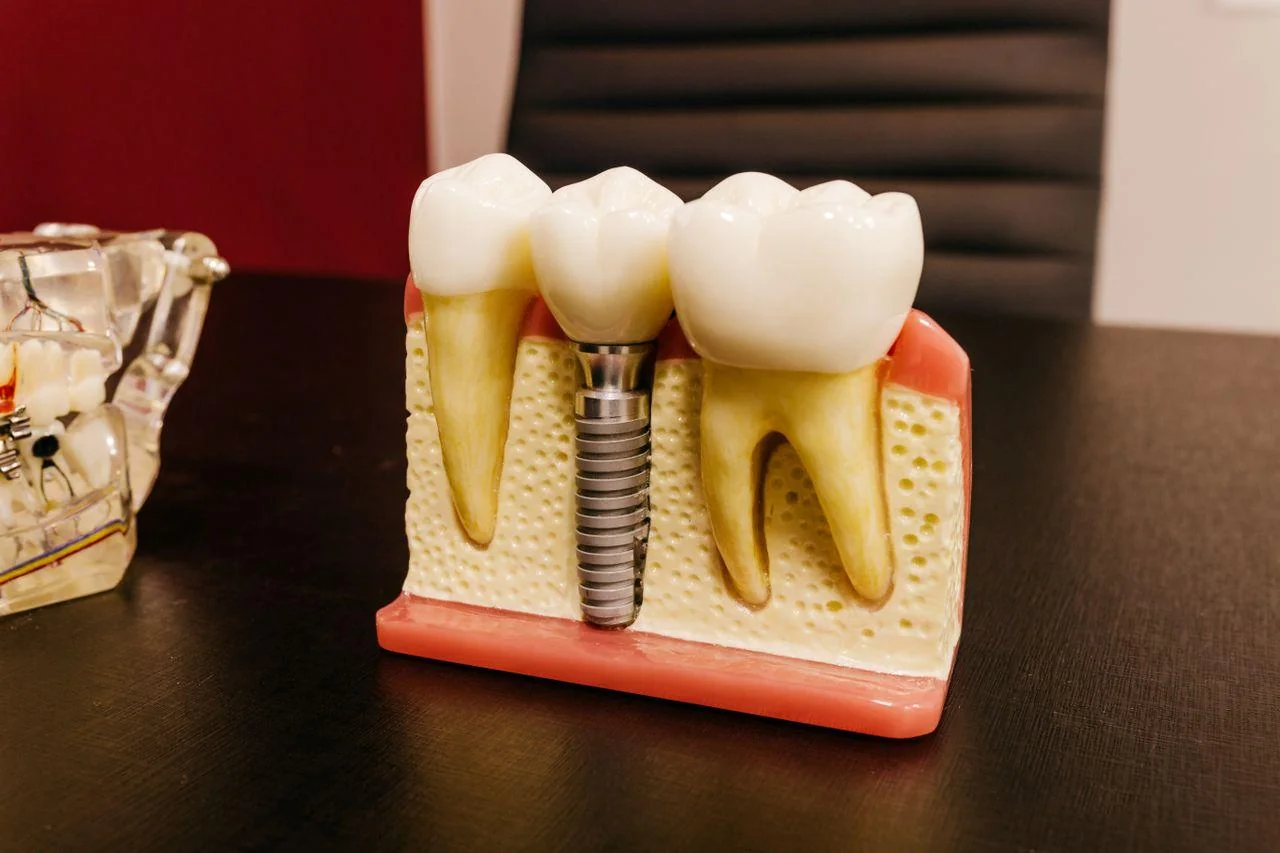 Implant dentar asistat laser: beneficiul depinde de rolul exact al laserului